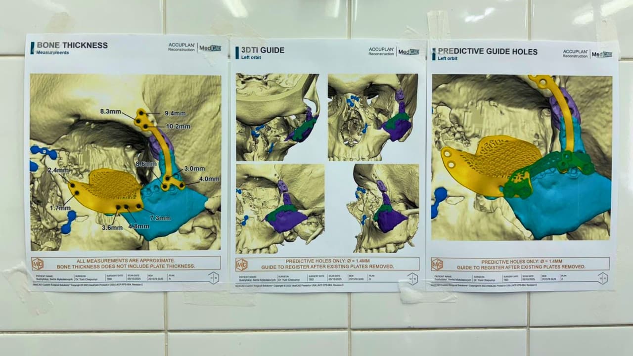 Guías e implantes personalizados diseñados a partir de tomografías para reconstrucción facial en Ucrania.