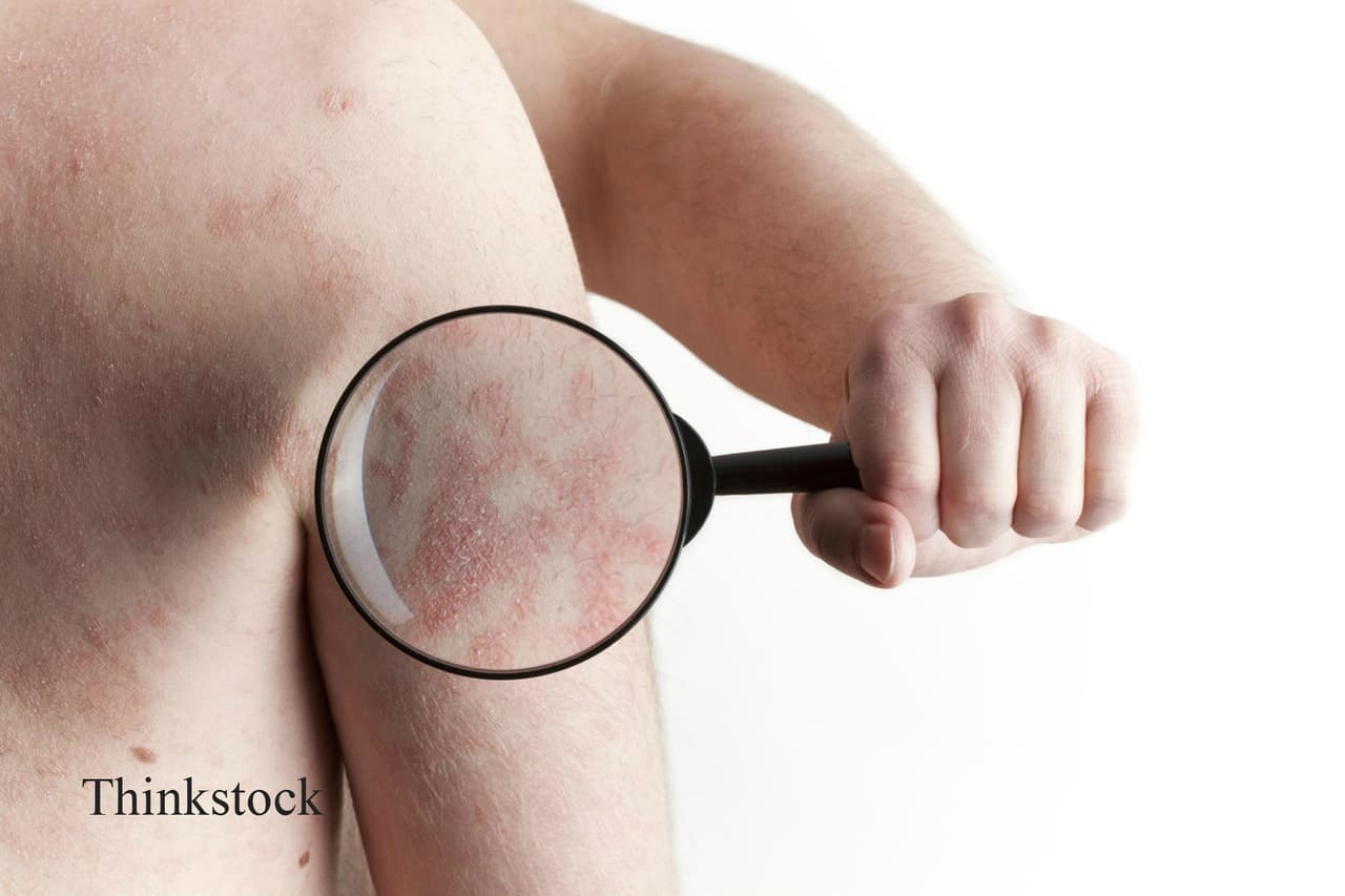 Piden un abrazo para los pacientes de psoriasis