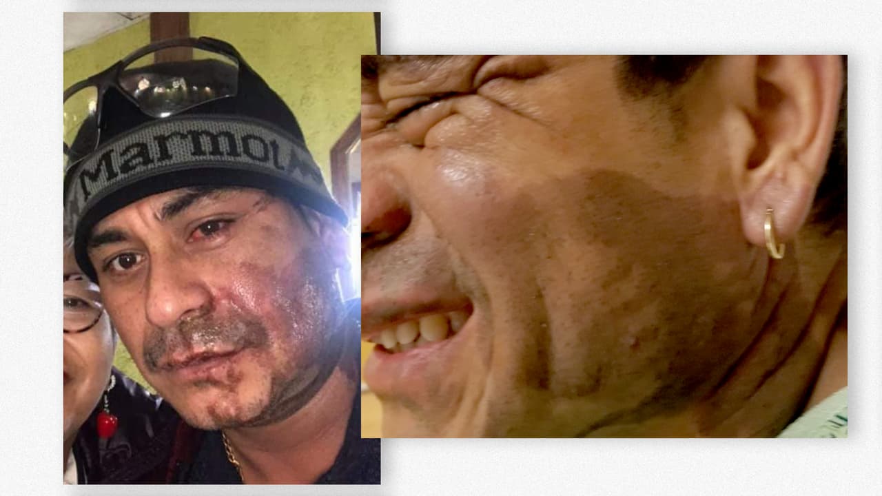 Villalaz sufrió quemaduras de segundo grado en el rostro, producto de un ataque con ácido.