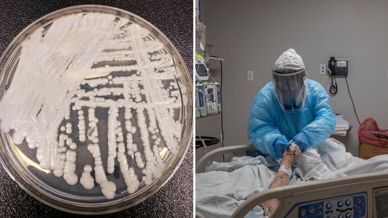 Un hongo resistente a los fármacos se extendió en dos ciudades de EEUU, según los CDC 