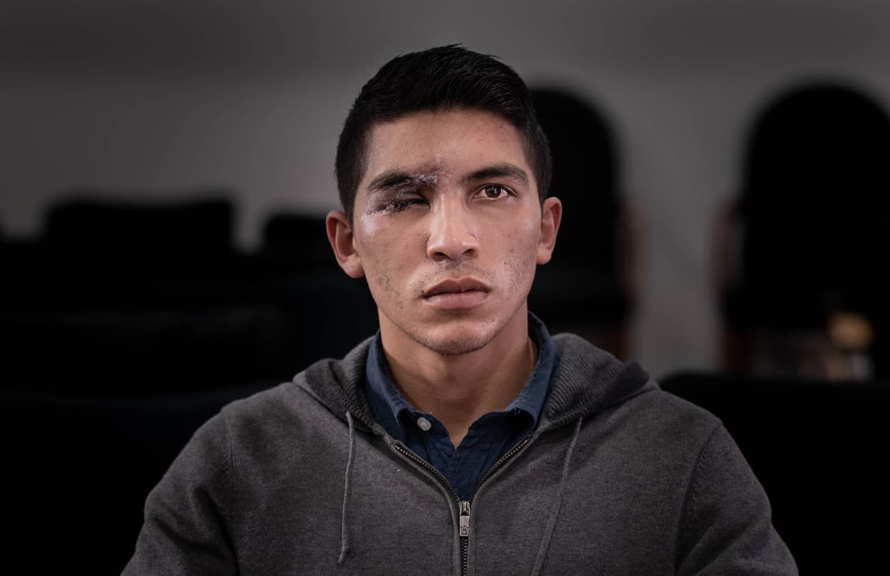 Dilan Yesid Suárez, de 21 años, denuncia que un miembro del ESMAD le disparó en el rostro, durante una protesta en Bogotá, causándole 13 fracturas y la pérdida del ojo.