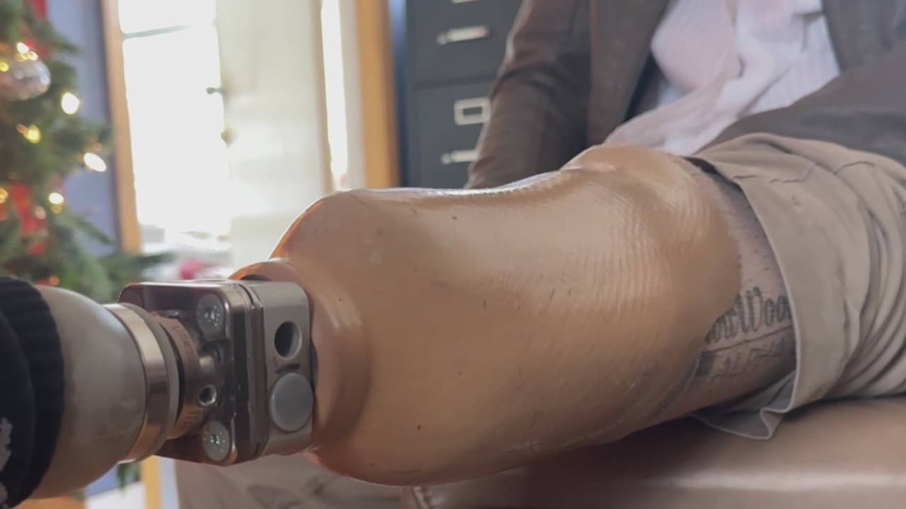 Inmigrante que perdió su pierna cuando ingresaba a EEUU ahora enfrenta la deportación