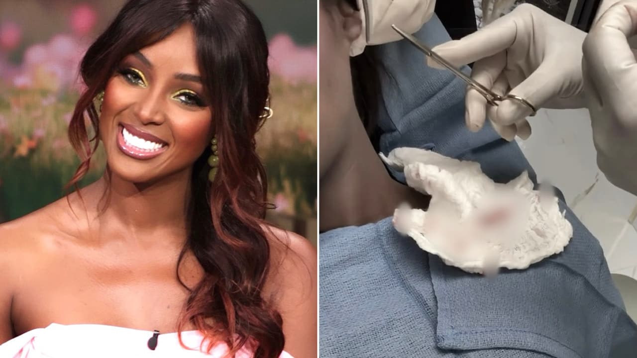 Amara La Negra se somete a procedimiento estético en la oreja y así se ve ahora