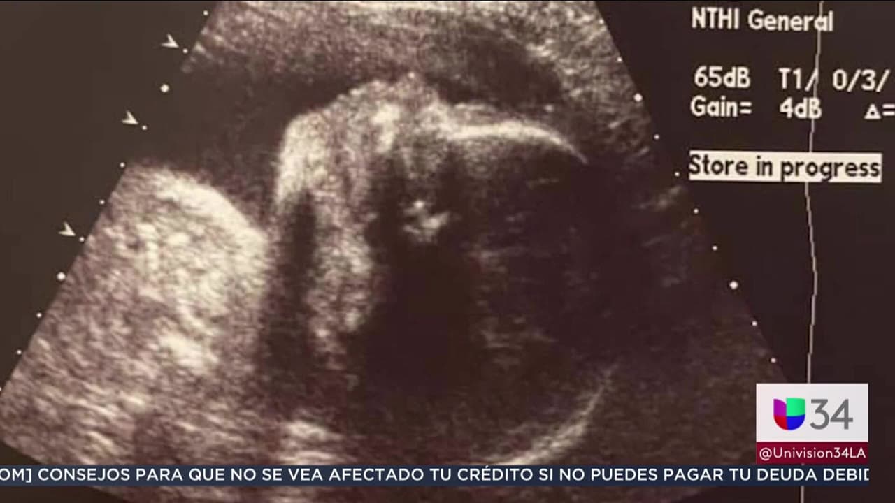 Los médicos realizaron una cesárea de emergencia, para extraer a la bebé del cuerpo de su madre. De acuerdo con Jaime, la infanta tenía "20 minutos sin vida" y los médicos trataron de resucitarla.