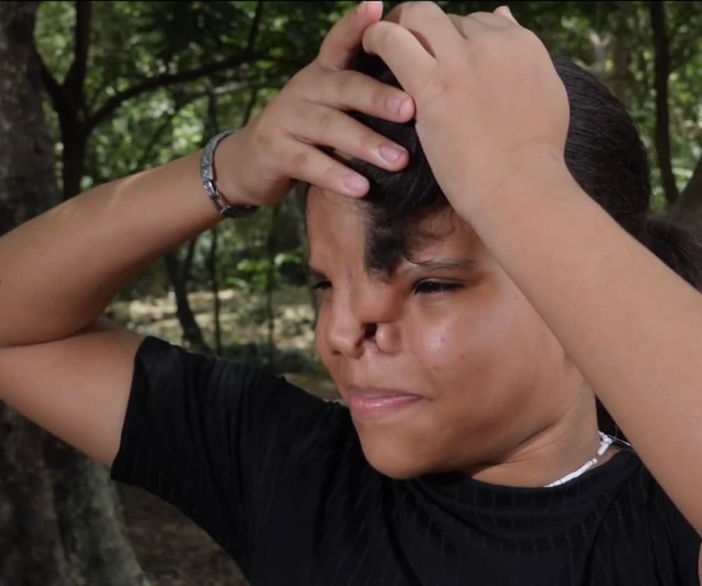 Sin embargo, con el levantamiento de las medidas y el regreso paulatino a la normalidad, Luz María volvió a aislarse al no estar dispuesta a seguir aguantando las burlas de los demás por su deformidad en su frente -que logra tapar un poco con su flequillo- pero, sobre todo, la de la nariz que le impide respirar correctamente. 
<br>