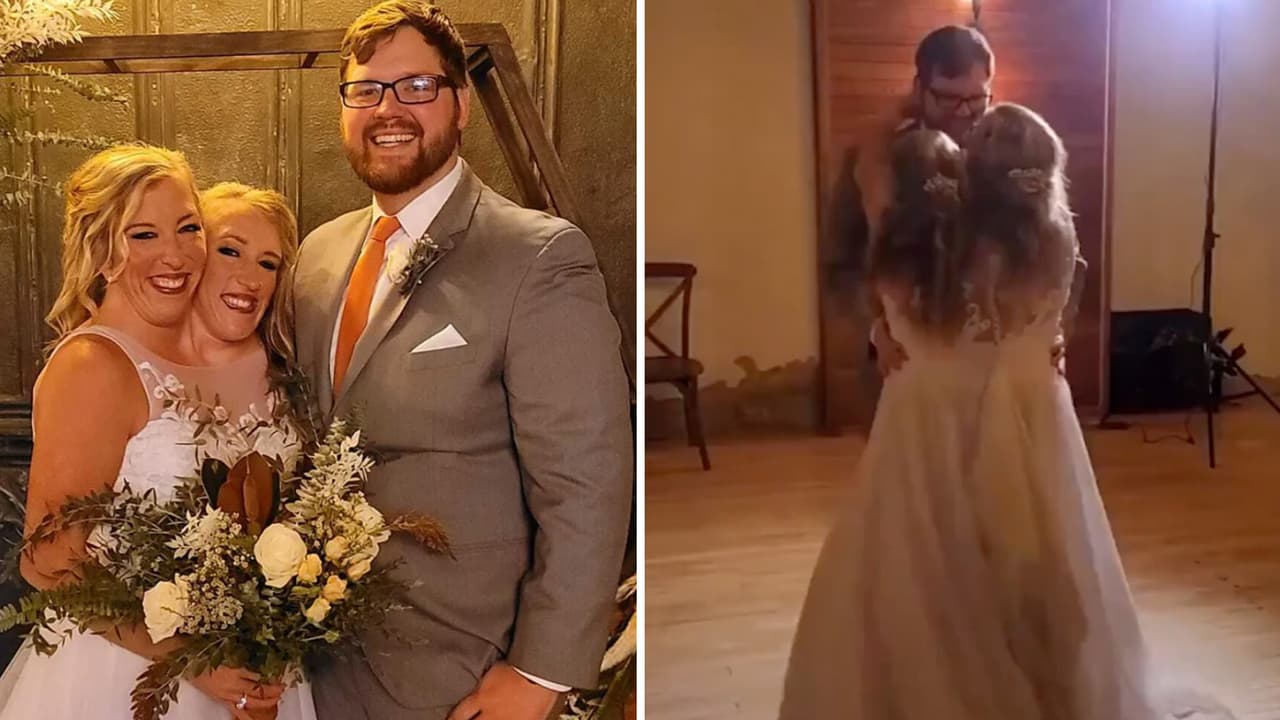 Siamesas revelan cómo es su vida amorosa al estar unidas: una está casada y la otra no 