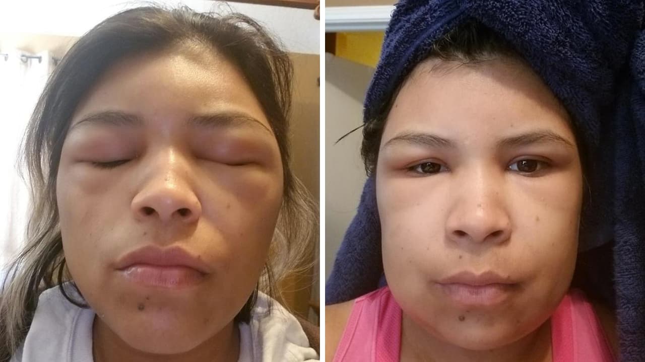 El efecto del químico también hizo que tuviera una inflamación en el rostro.