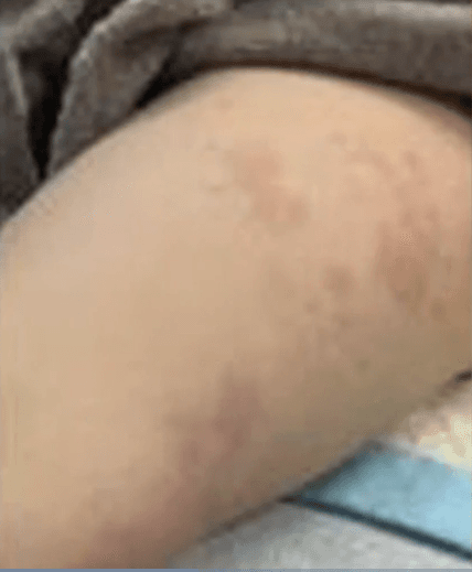 “Se puede ver una inflamación en las arterias y lo que nos preocupa de eso, es que puede afectar el corazón”, dijo Marcos Mestre, el director del servicio médico del Nicklaus Children’s.