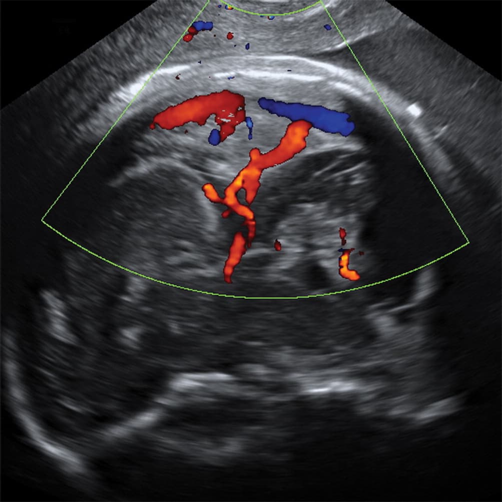 A la décima semana de embarazo el tamaño de la cabeza del feto ya se había reducido desproporcionadamente.