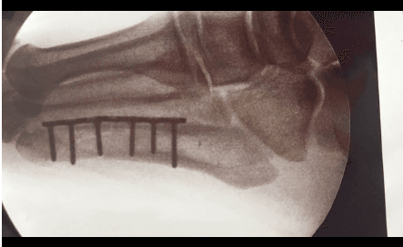 En un video que compartieron en sus redes sociales, la doctora que lo intervino explicó de qué se trata la lesión.