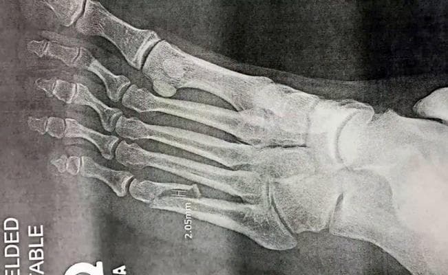 Lamentablemente el cantante tendrá que cumplir con los compromisos que están pactados, pero lo hará desde su silla de ruedas.