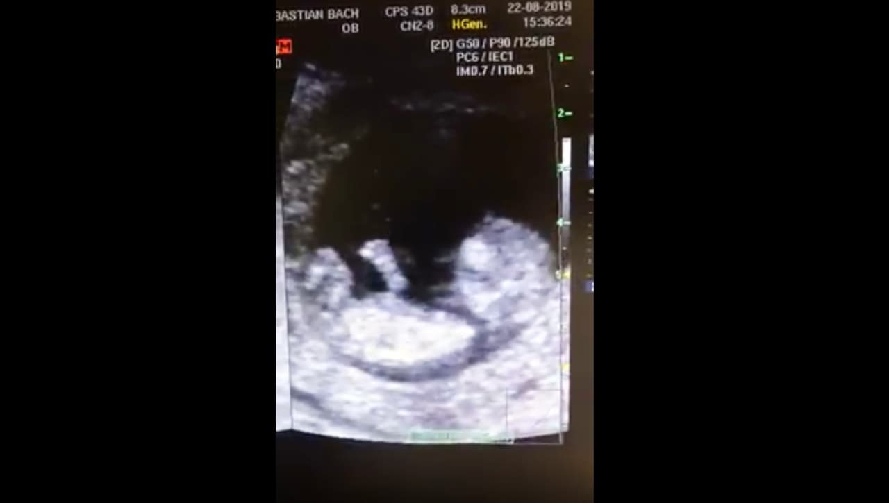  Sorprenden a bebé mexicano  jugando "a la resbaladilla" en el vientre materno 
