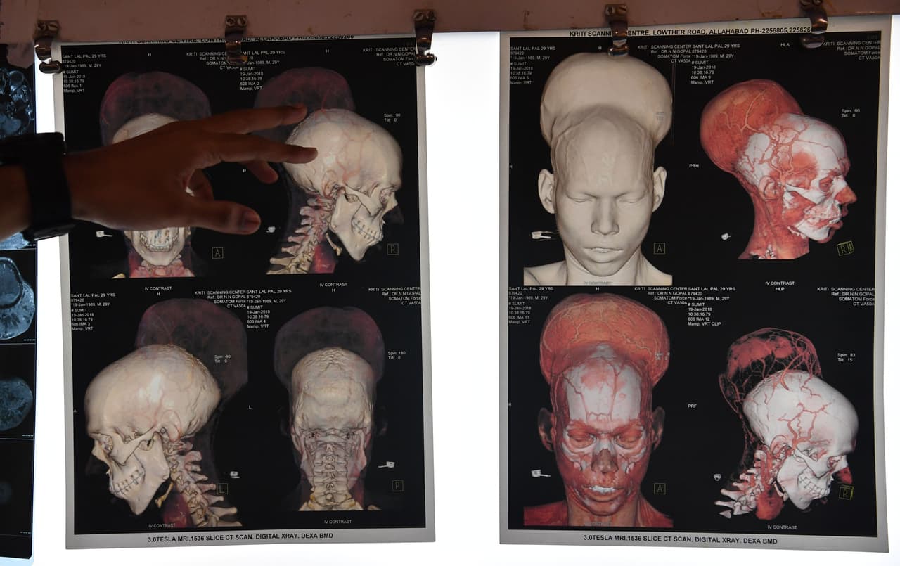 Indian doctor Ramanuj Kabra points to brain scans of Santlal Pal, 31, at the BYL Nair hospital in Mumbai on February 22, 2018. Indian surgeons who removed a massive brain tumour in a marathon seven-hour procedure said on February 22 it could be the heaviest ever recorded. Santlal had been carrying around a tumour weighing nearly two kilos before the surgery on February 14. / AFP PHOTO / INDRANIL MUKHERJEE (Photo credit should read INDRANIL MUKHERJEE/AFP/Getty Images)