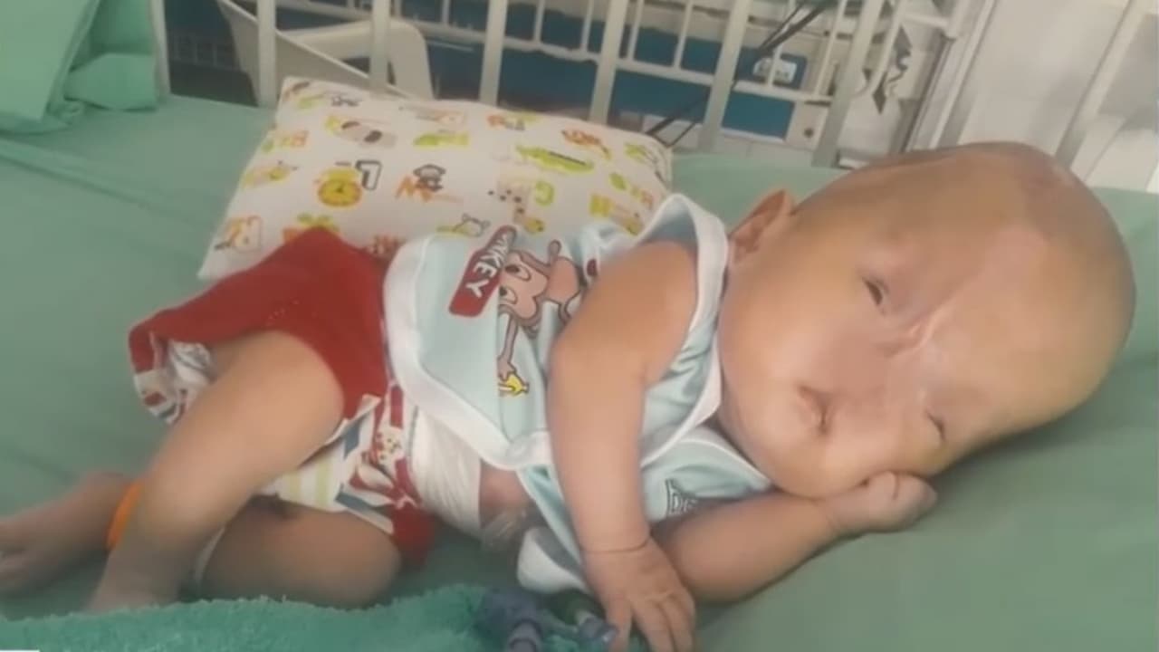 Ayuda de Impacto: Este niño no tiene paladar, labio y ni gran parte de nariz