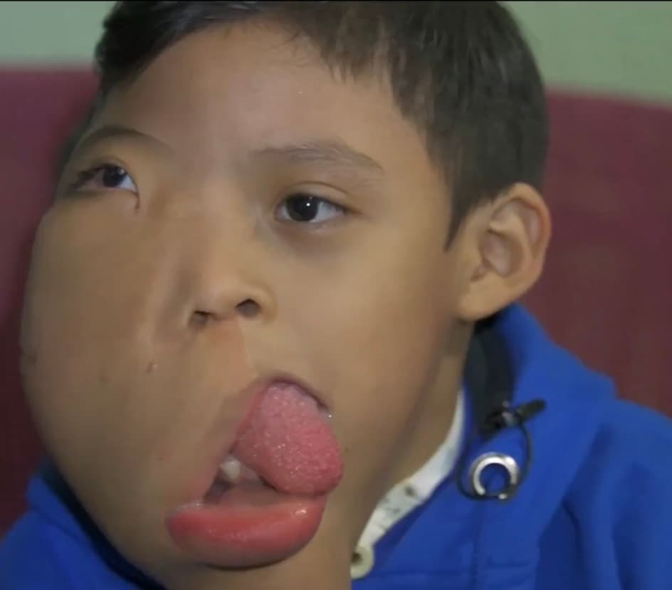 Durante 6 años de vida, Moisés Tecún 
<b>ha tenido que soportar las burlas de otros niños que se ríen al verlo con esa seria malformación en su rostro</b>, por lo que se la pasa pidiéndole a Dios que lo pueda curar y tener un rostro como los demás, aunque acepta que no siente ningún dolor físico. 
<br>