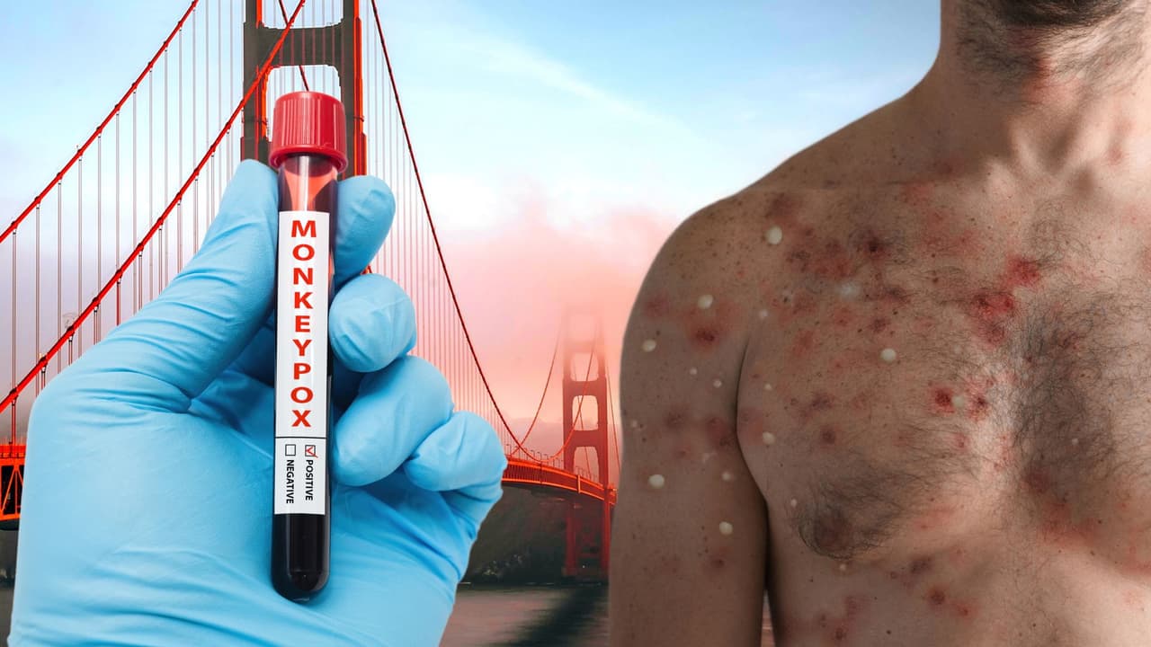 Reabre clínica de vacunación contra la viruela del mono en San Francisco
