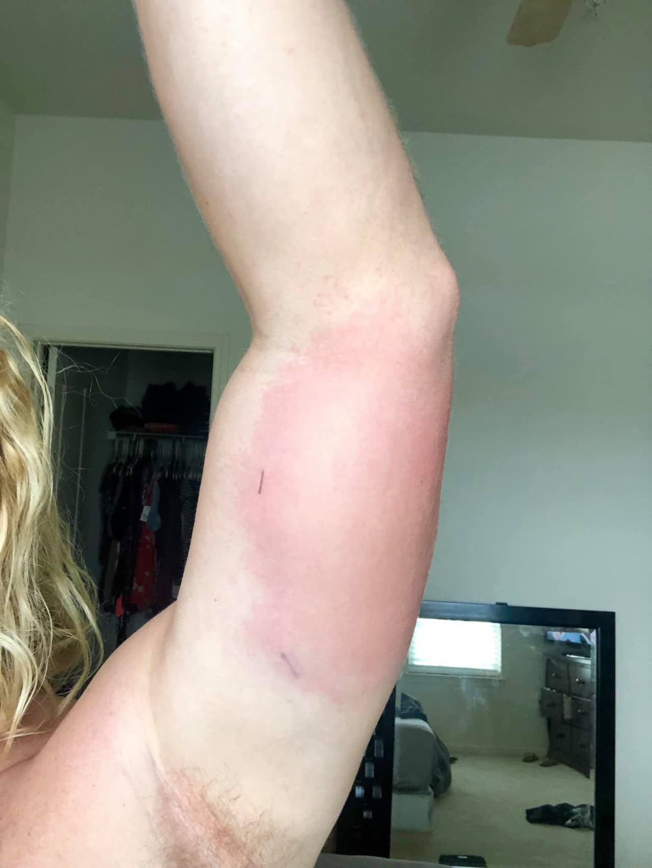 Uno de los primeros síntomas es el enrojecimiento de la piel, seguido de una fuerte hinchazón.