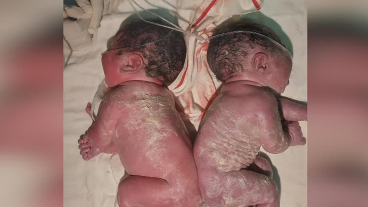 <b>Mira el caso completo y haz <a href="https://www.univision.com/shows/primer-impacto/ayuda-de-impacto-bebes-siameses-que-fueron-separados-necesitan-seguir-en-tratamientos-medicos-peru" target="_blank">clic aquí para conocer cómo ayudarlos</a></b>.