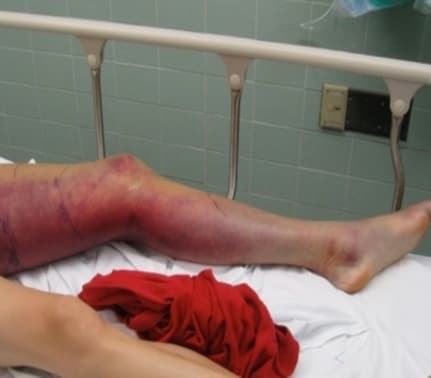 Otros síntomas pueden incluir visión borrosa, dolor intenso, vómito y adormecimiento del área afectada.