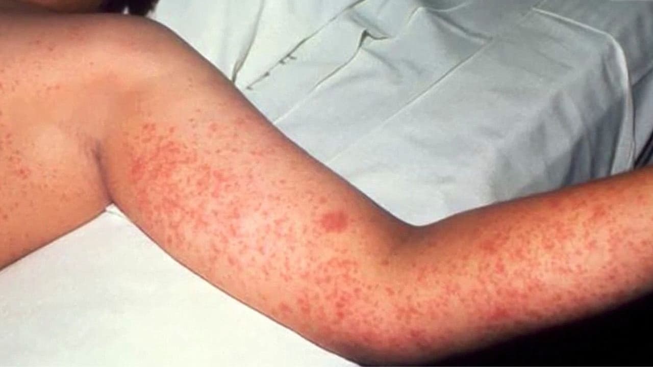 Sarampión alcanza su nivel más alto en 35 años en EEUU: ¿Cómo prevenir el contagio?