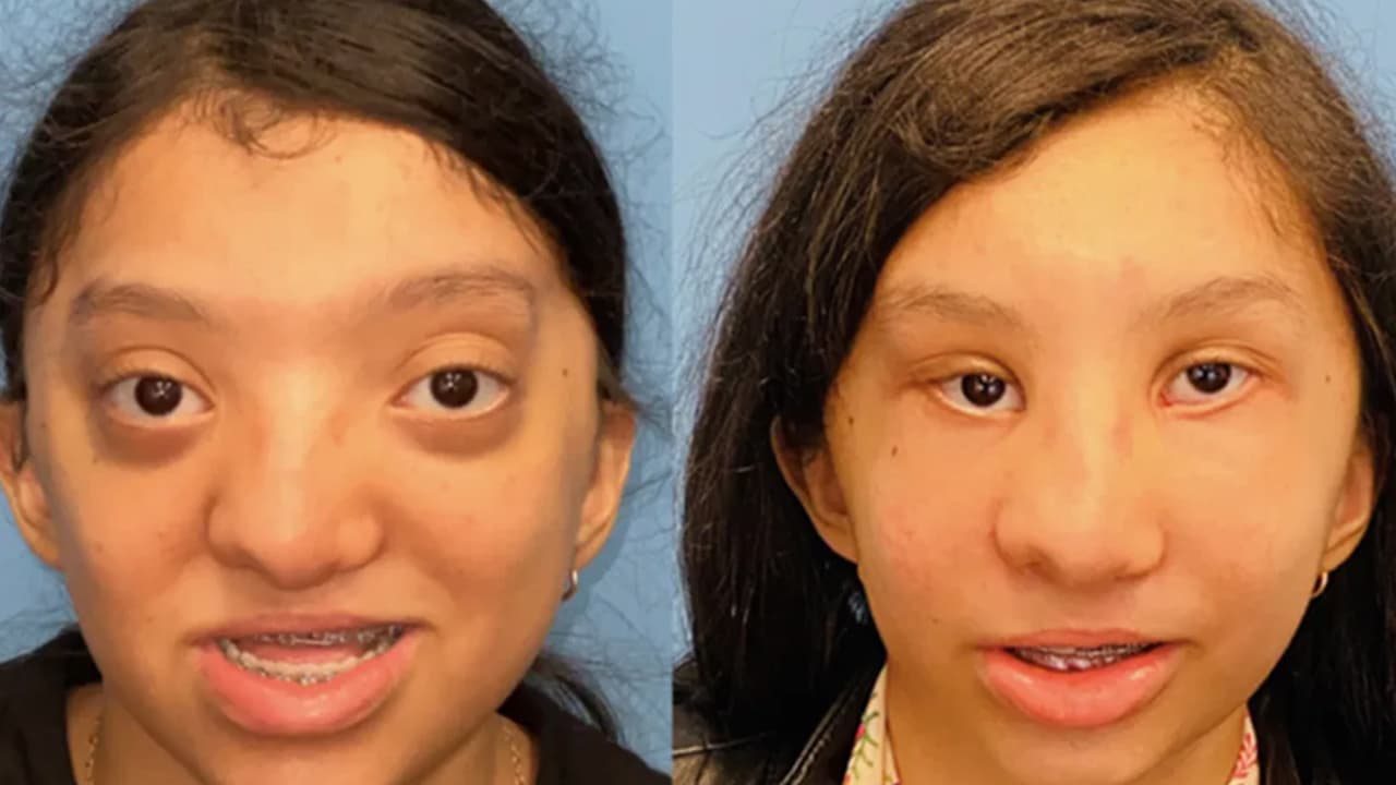 Taína Martínez antes (izquierda) y después (derecha) de la operación.