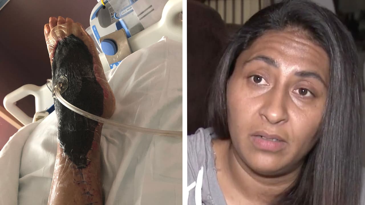 "Me duele bastante, no puedo caminar": madre hispana se salva de perder su pie por la bacteria 'come carne'