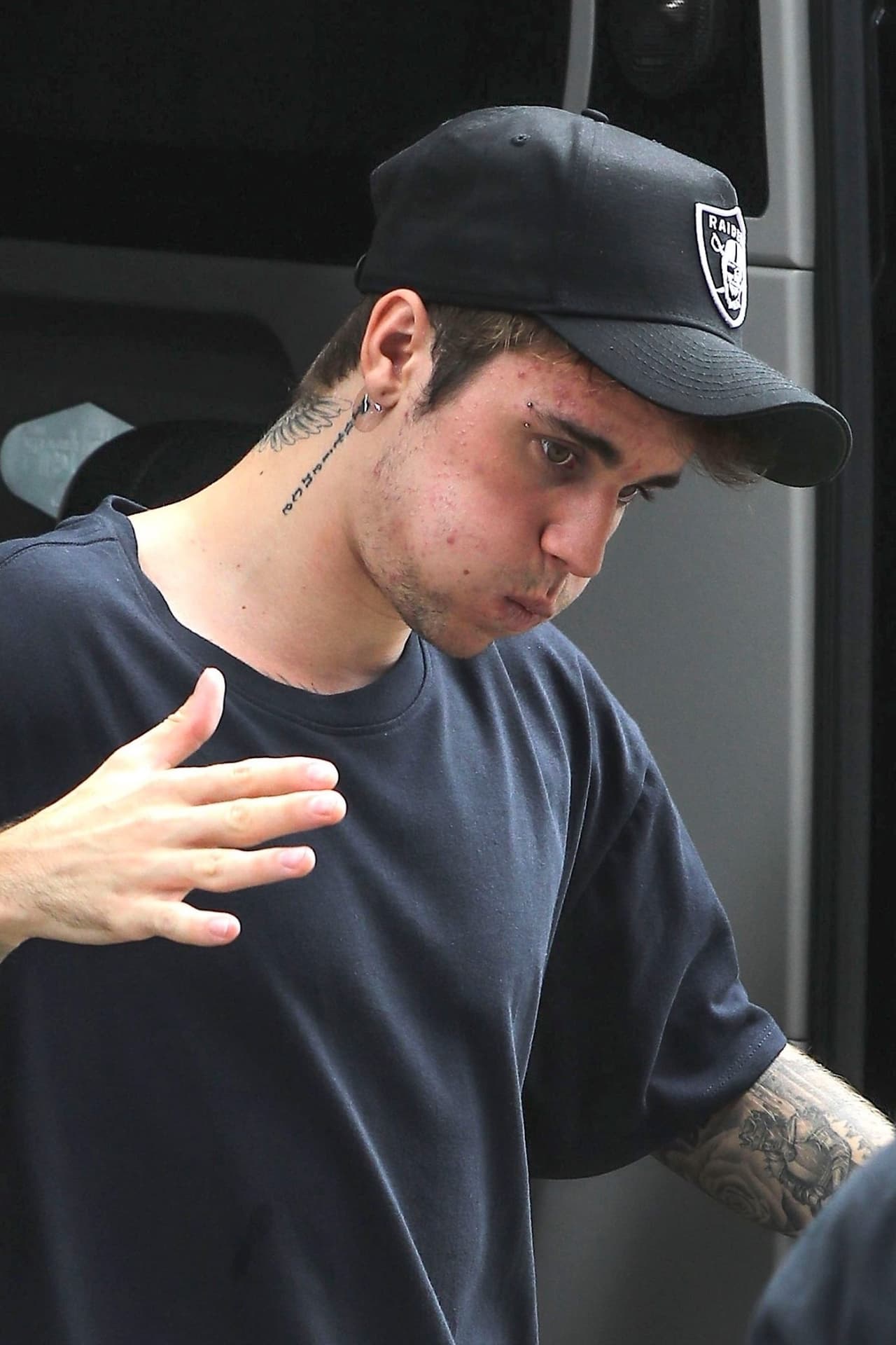 De acuerdo con la revista 
<b><a href="https://mx.hola.com/belleza/20180323122028/justin-bieber-acne-body-positive-gt/" target="_blank">¡Hola!</a></b>, el canadiense sufrió un problema de acné en 2010, situación que no fue agradable para él.