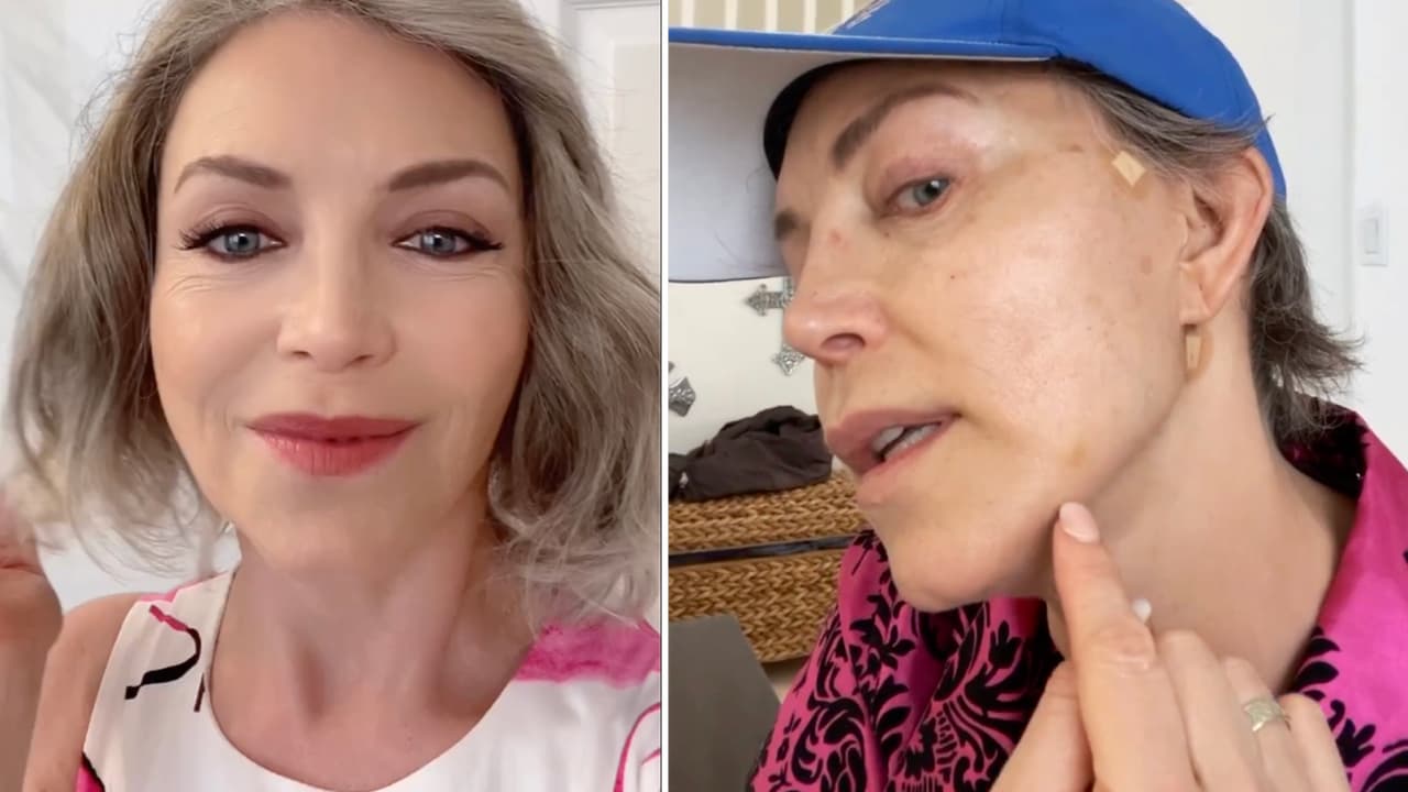 Laura Flores somete su rostro a hilos tensores a sus 59 años y muestra el resultado: “¡Estoy feliz!”