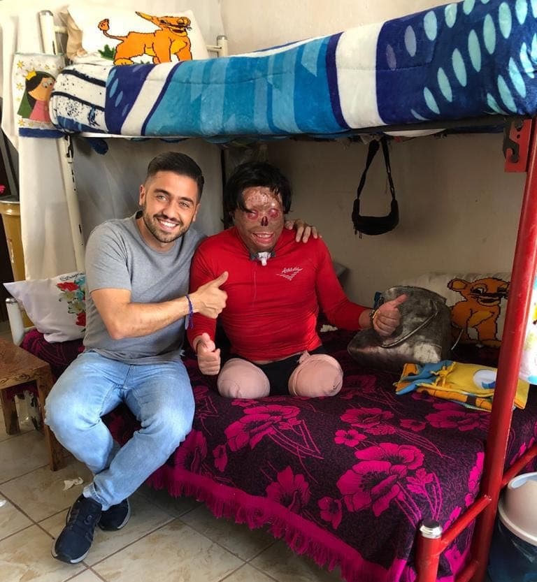 Una descarga eléctrica lo dejó desfigurado y ahora este joven pide ayuda para tener un nuevo rostro