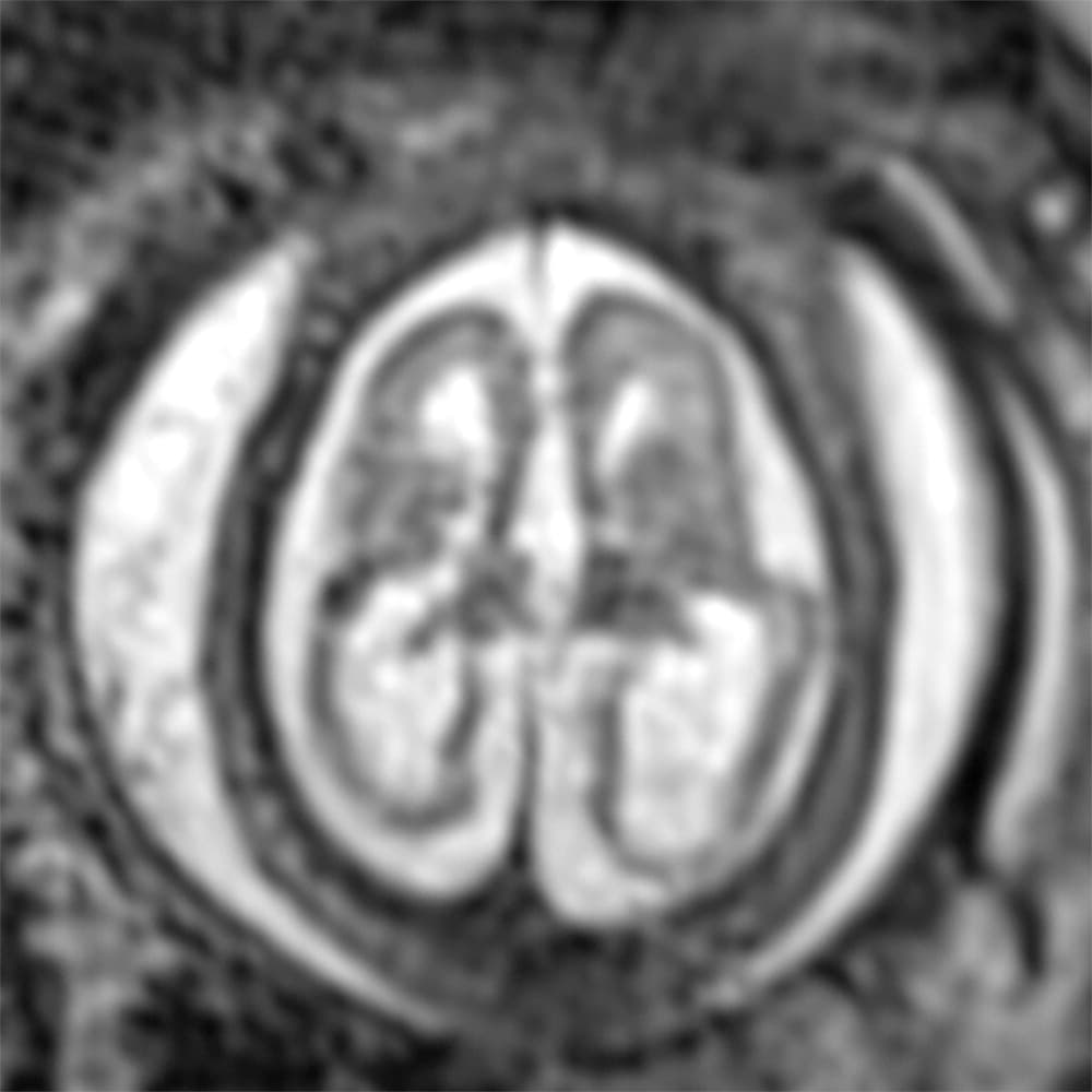 A las 14 semanas de gestación el tamaño de la cabeza de ambos bebés era normal.