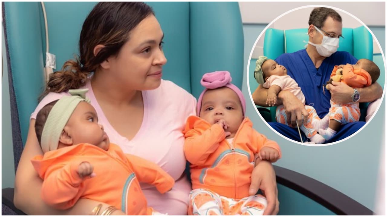 “Es una bendición”: Bebés siamesas de madre hispana separadas con éxito por médico colombiano en Texas