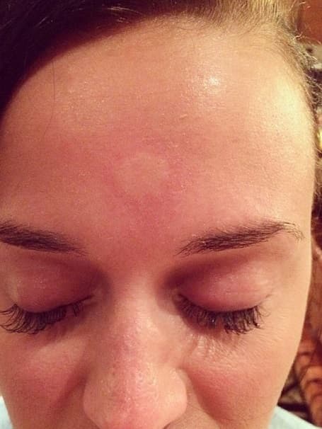 A Katy la picó un mosquito y lo compartió en sus redes sociales. Esta fue otra de sus selfies desafortunadas.