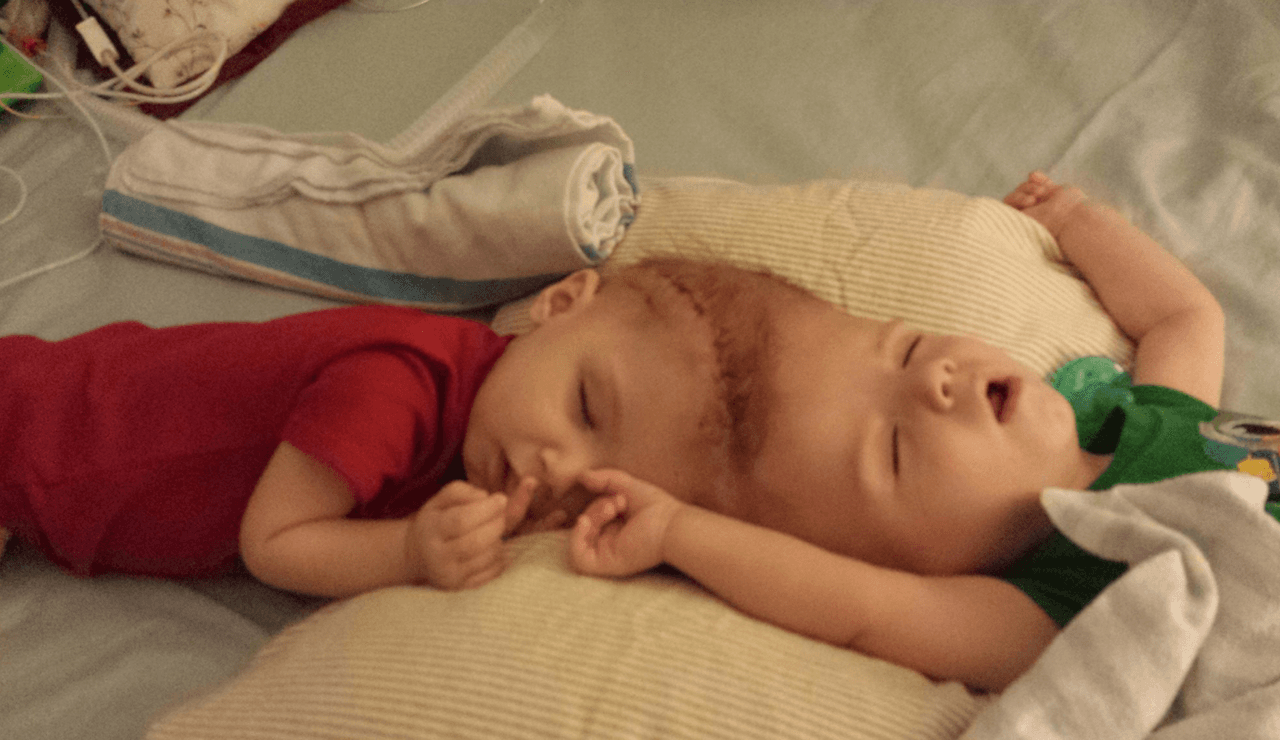 Anias y Jadon horas antes de ser sometidos a la operación que los separó.