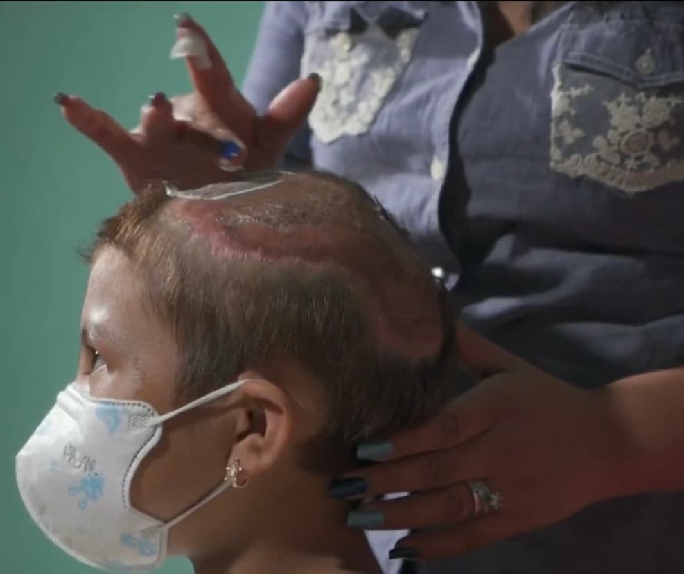 Aunque los dueños del perro resultaron ser familiares cercanos que se deshicieron del pitbull tras el incidente,
<b>lamentablemente no se han hecho cargo de los costos médicos</b> y, para colmo de todos los males, Pérez perdió su trabajo, dejando a la familia en una difícil situación económica.
<br>