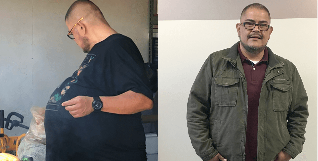 La imagen muestra a Héctor Hernández antes y después de la cirugía. El tumor pesaba 77 libras.