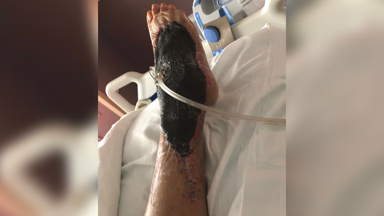 La madre hispana no tiene movilidad total del pie, dice que por momentos siente "punzadas" y asegura que dormir le cuesta mucho por la posición que debe permanecer.