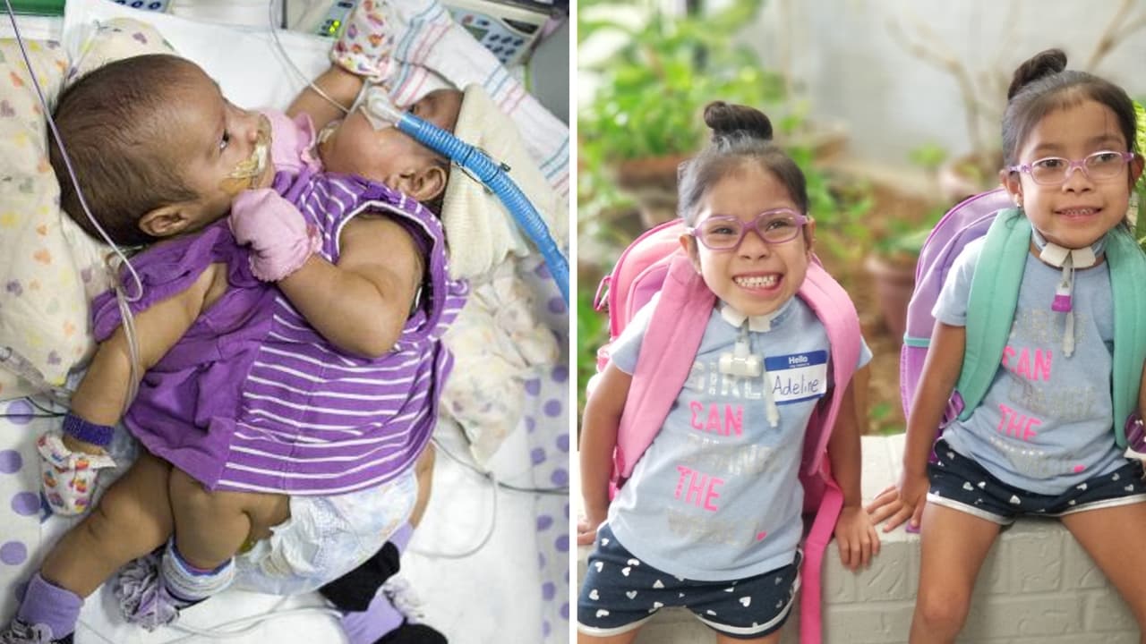 Inician el prekinder las mellizas hispanas que nacieron unidas y fueron separadas en Houston en 2015