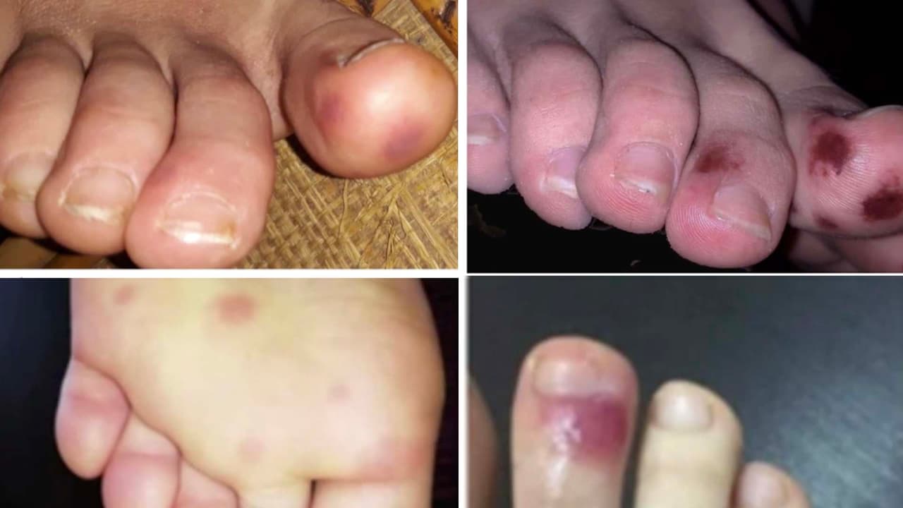 Lesiones en los dedos de los pies: otro posible síntoma de pacientes con coronavirus 