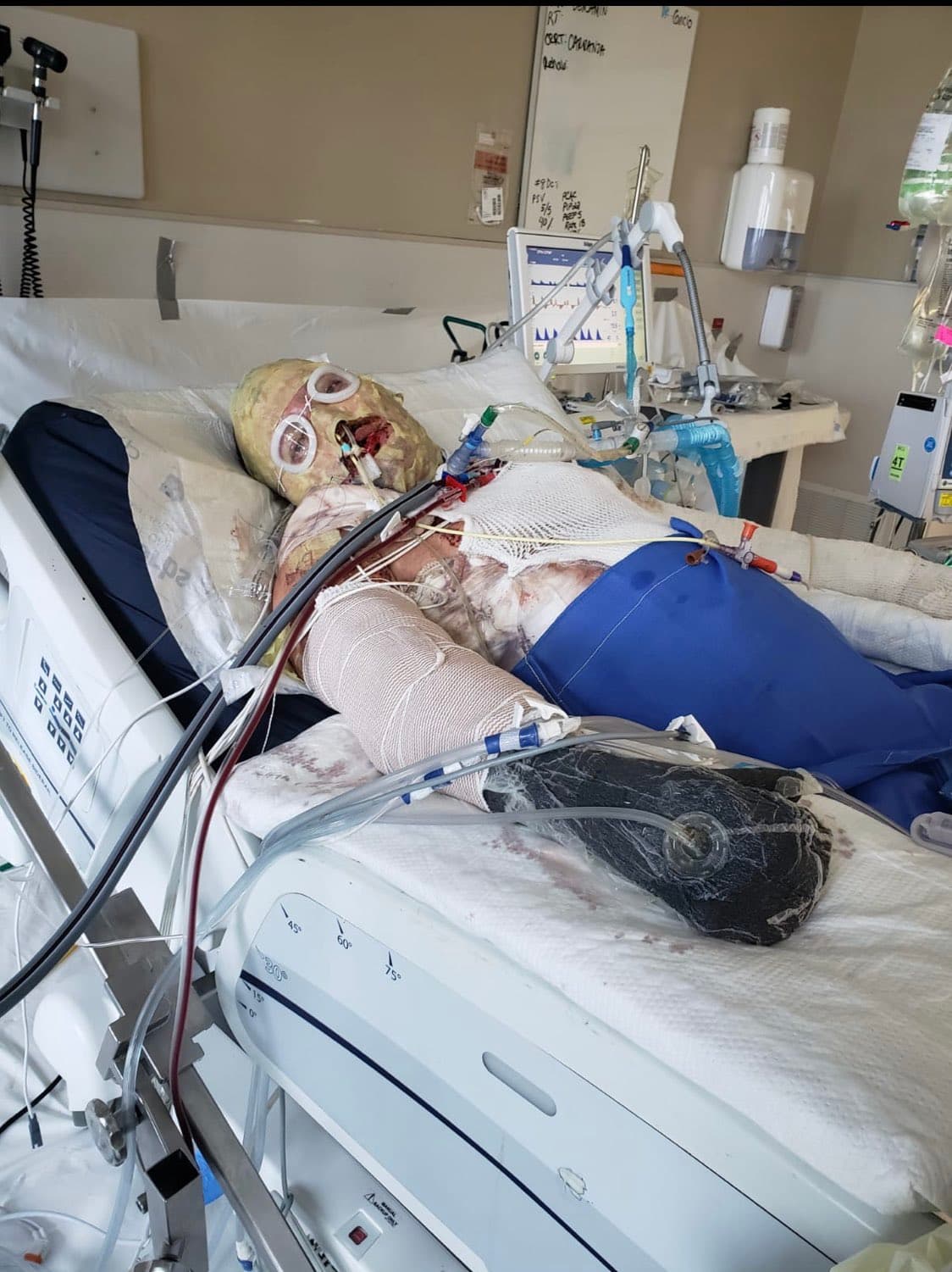 A pesar del dolor y el esfuerzo sobrenatural durante su recuperación, Hernández asegura que en este proceso se divirtió mucho, por lo que un día decidió publicar una foto. 
<br>