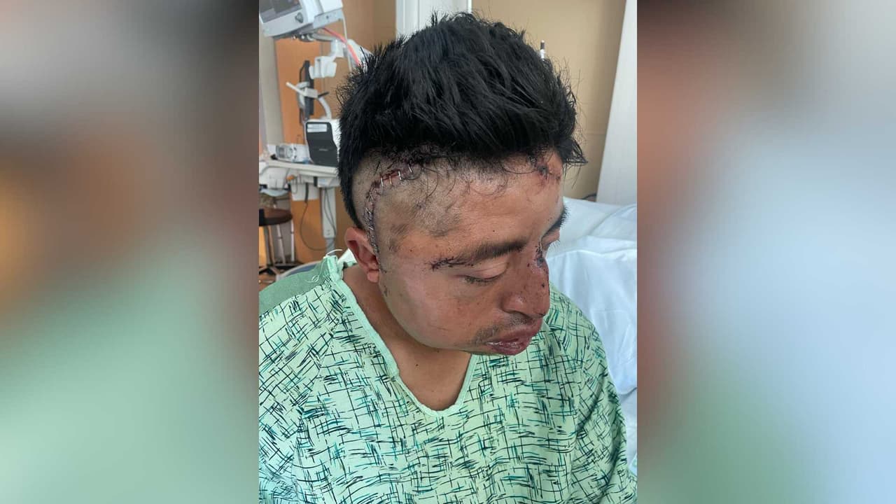 La esposa de Hernández, quien no se ha separado de su lado desde el ataque, ha estado recibiendo apoyo financiero de la comunidad para enfrentar esta difícil situación.