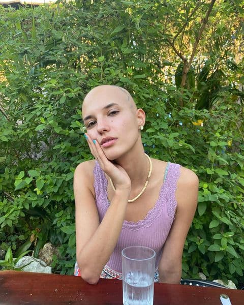 De acuerdo con lo que la modelo ha compartido en su cuenta de Instagram, ella vivió 24 años ocultando que 
<b><a href="https://www.univision.com/shows/despierta-america/calvicie-causa-tipos-y-al-alternativas-para-combatirla-video" target="_blank">padece alopecia areata</a></b> hasta que se aceptó tal y como es.
<br>