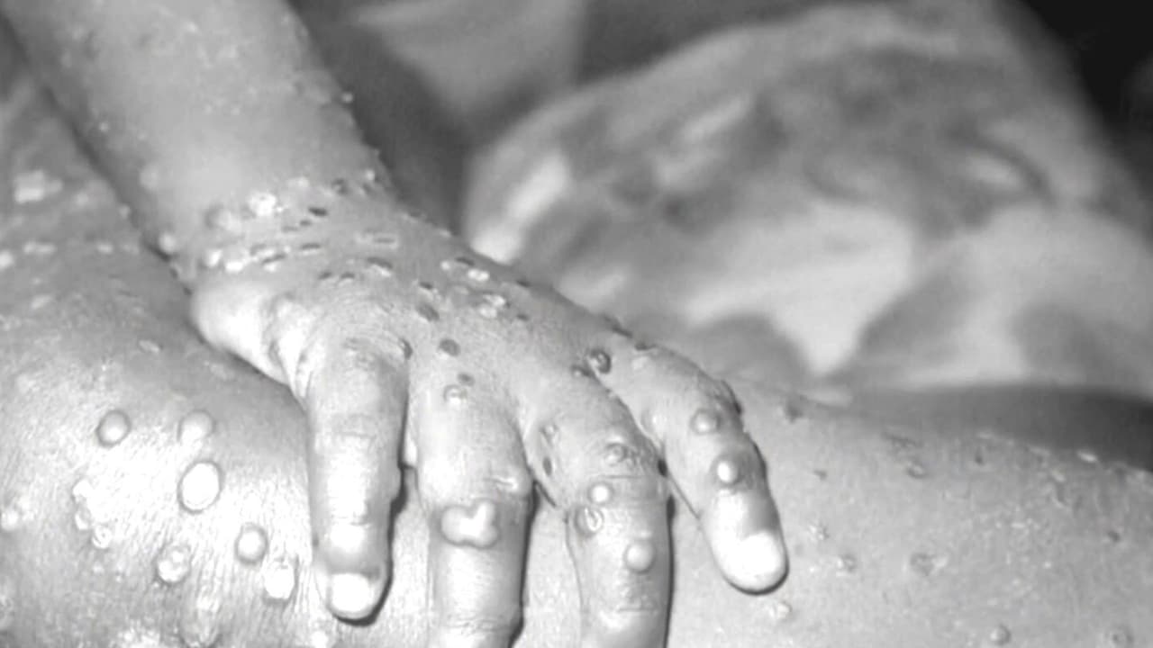 Ya hay dos personas aisladas en el condado Broward, por 
<a href="https://www.univision.com/local/miami-wltv/mantienen-persona-aislada-en-broward-detectan-posible-caso-de-viruela-del-mono?dwd" target="_blank">presuntamente tener viruela del mono. </a>