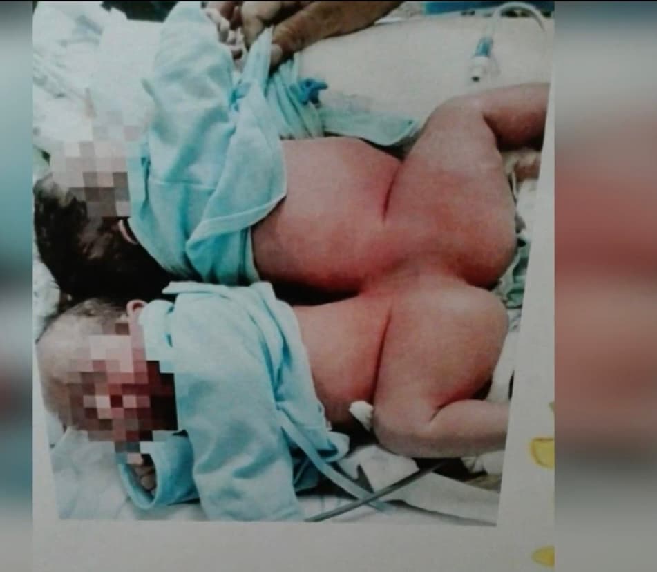 A pesar de las preocupaciones, Espinoza rememoró que al tener éxito en la cirugía
<b>“todo el equipo comprobó que los niños controlaban por si solos sus extremidades inferiores". </b>
<br>