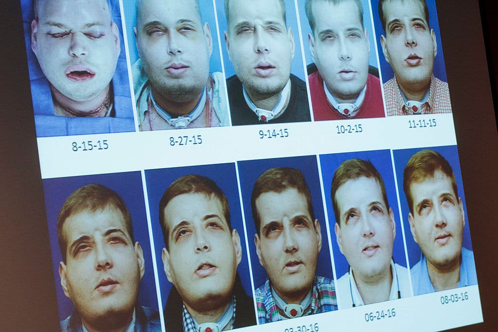 Patrick Hardison y el doctor hispano que le trasplantó un rostro celebran un año de recuperación 

