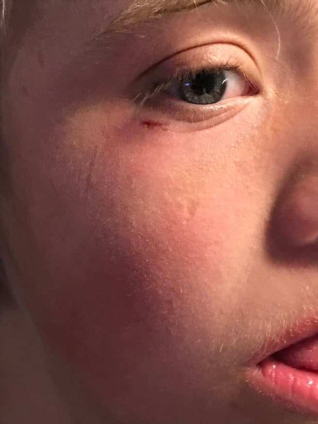 El 11 de enero de este año Luciano sufrió una pequeña herida debajo del ojo derecho: "No para uno con los sustos. Carlo con dolor de oído y Lu jugando se lastimó", publicó la actriz en Twitter.