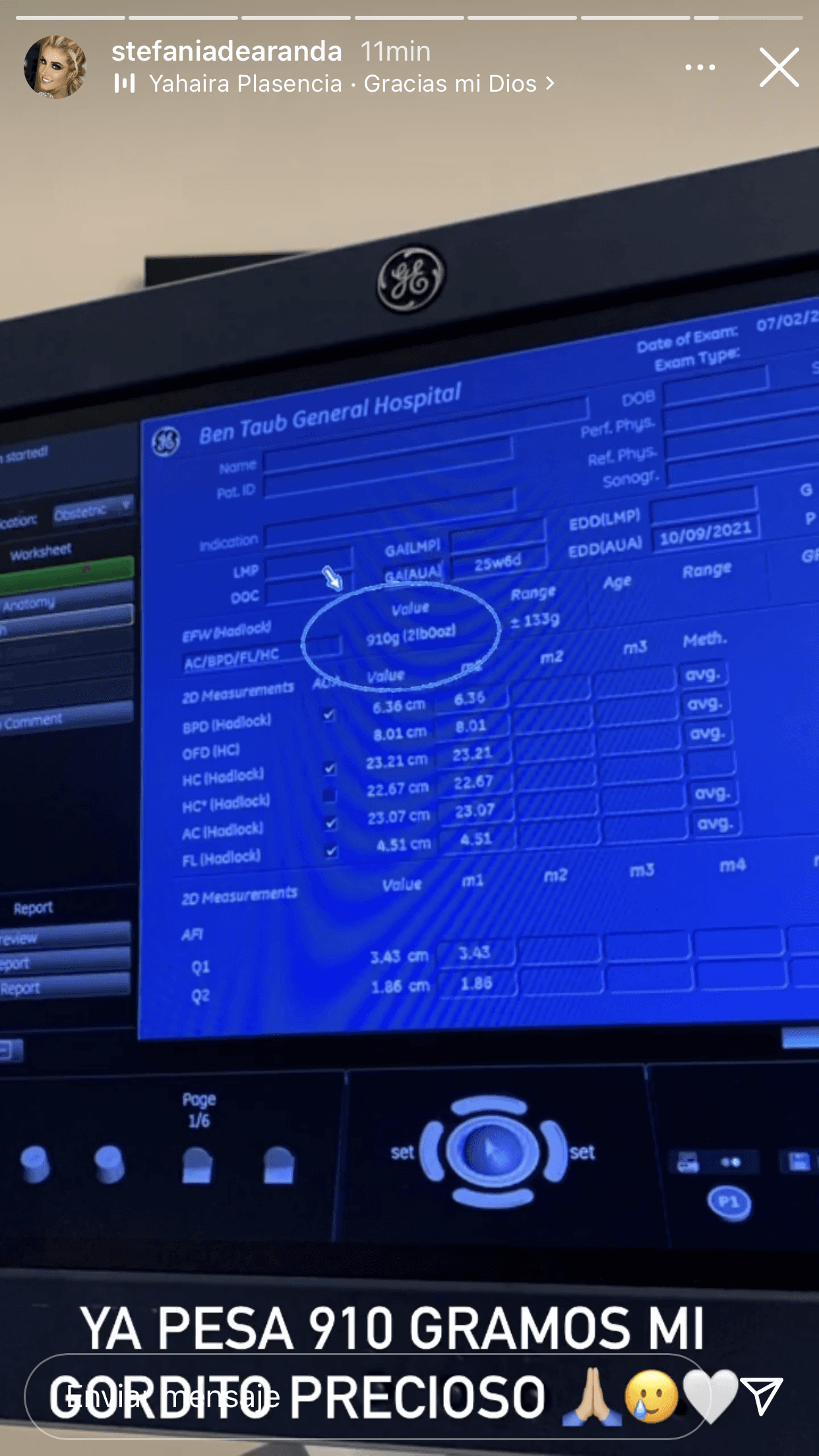 Luego de la cirugía, la presentadora y su bebé, ahora con poco más de 7 meses de gestación, se encuentran con buena salud, según lo que ha dado a conocer. Tras ser dada de alta la semana pasada, informó que su bebé ya pesaba dos libras. 
<br>