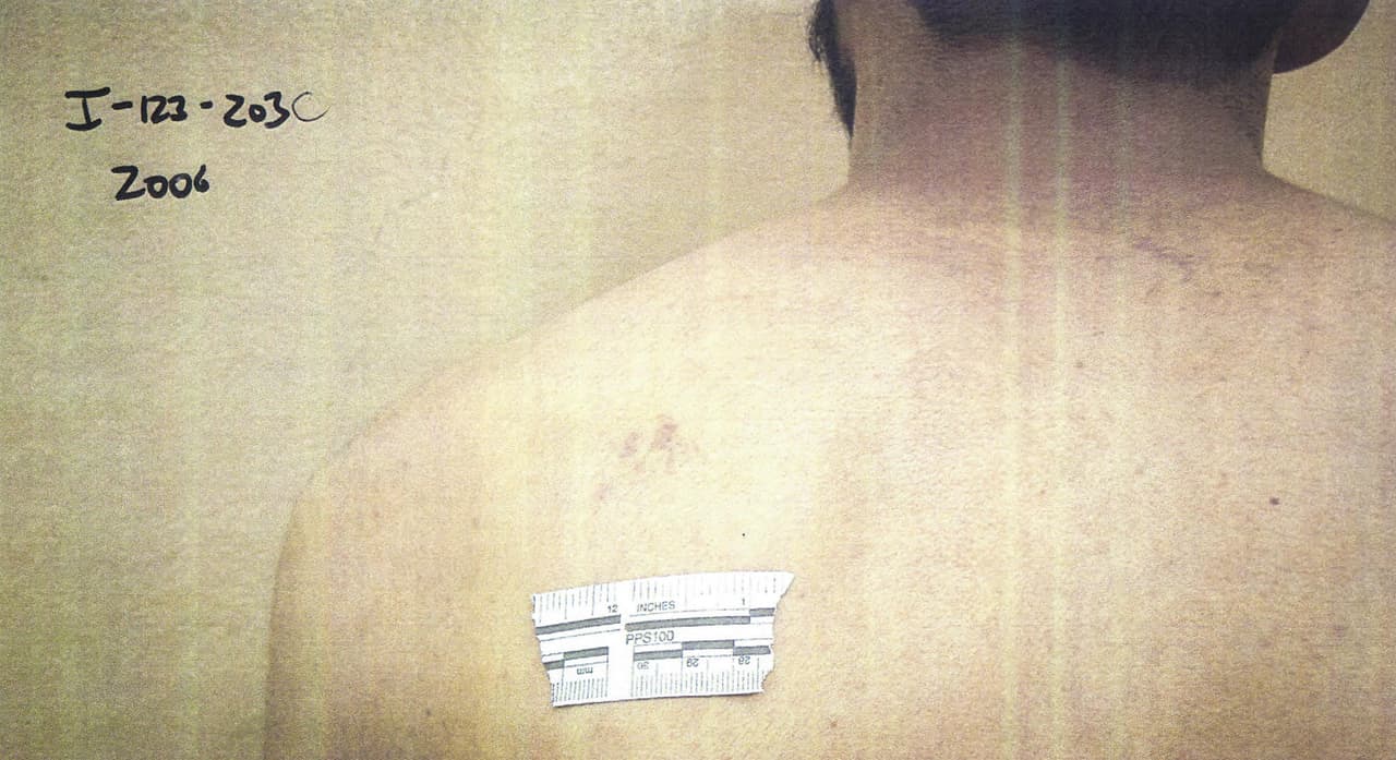 Moretones en la espalda