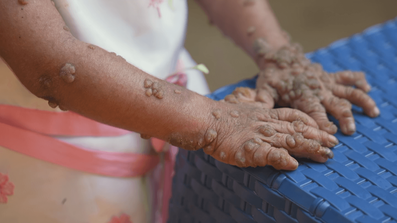Las marcas de la sarcoptosis, un trastorno de la piel que provoca sarpullido con picazón, que sufren las pequeñas.