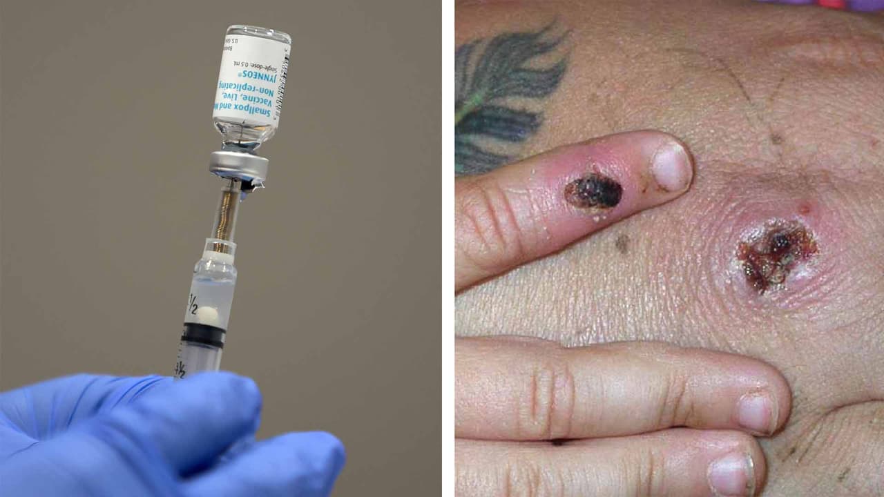 Residentes de Houston que quieran vacunarse contra la viruela del mono deben hacer una cita