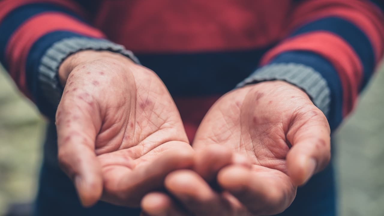 Si visitaste estos lugares en el sur de California, puede que estés en riesgo de contraer sarampión